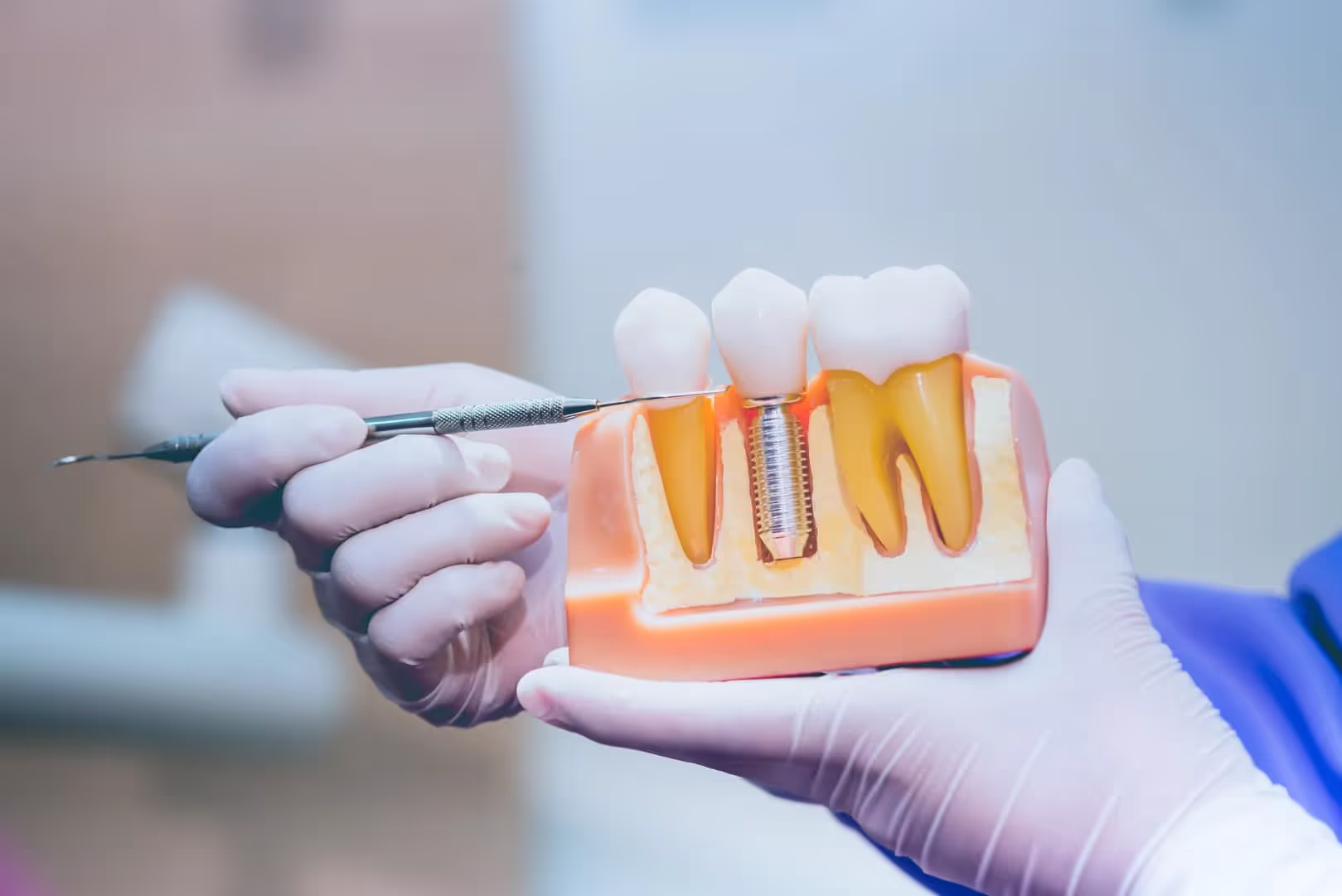 Dental implants Houston – example