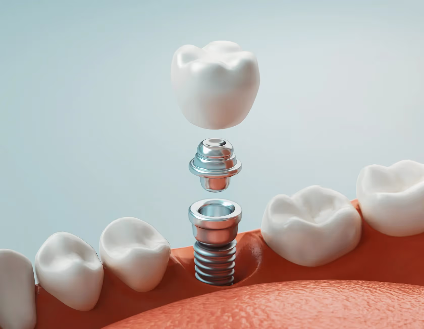 Cost of Dental Implants