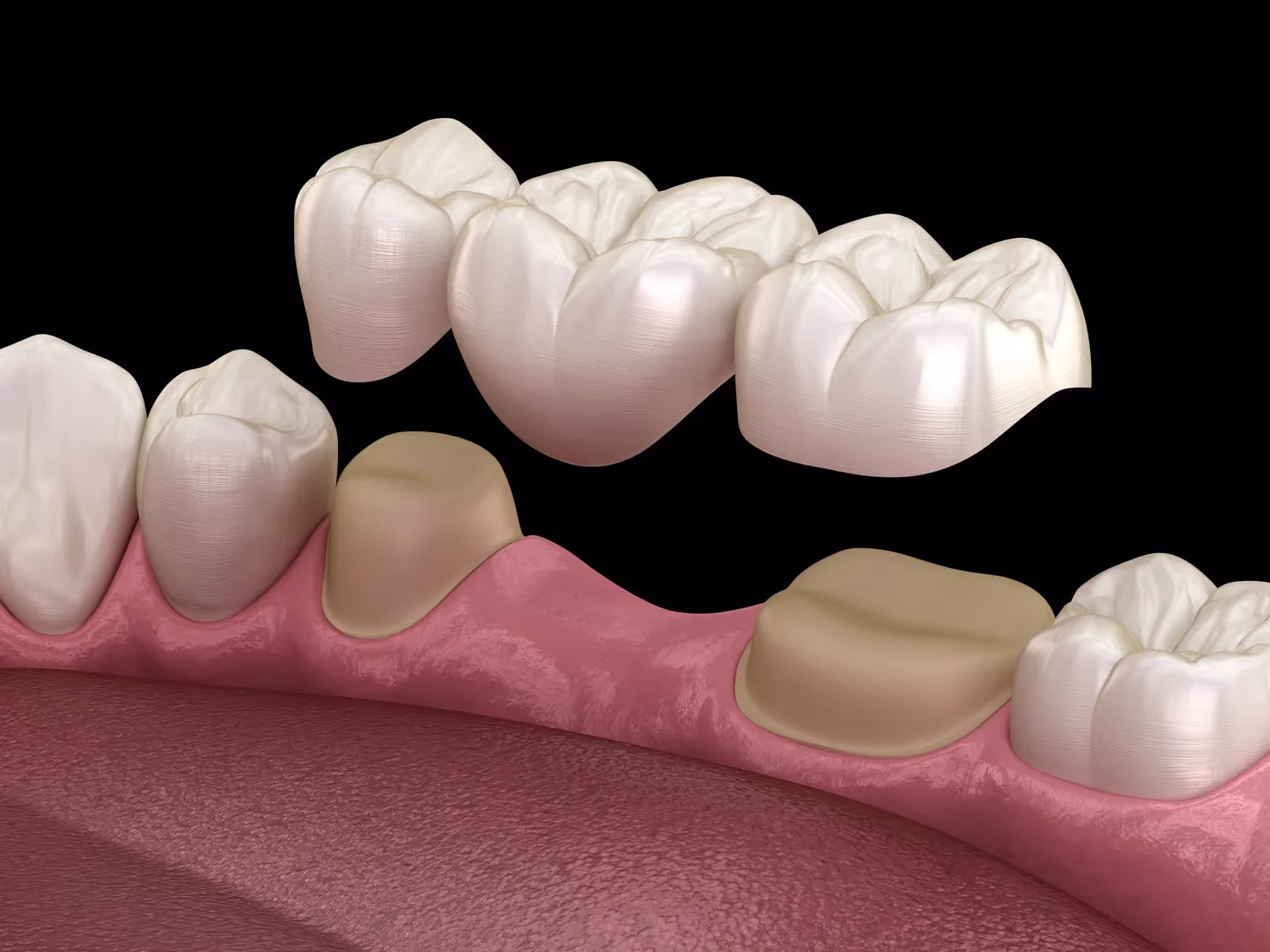 Dental Crowns & Dental Bridges