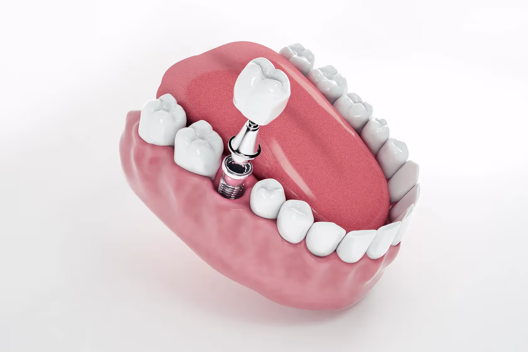 Fixed Implant Dentures