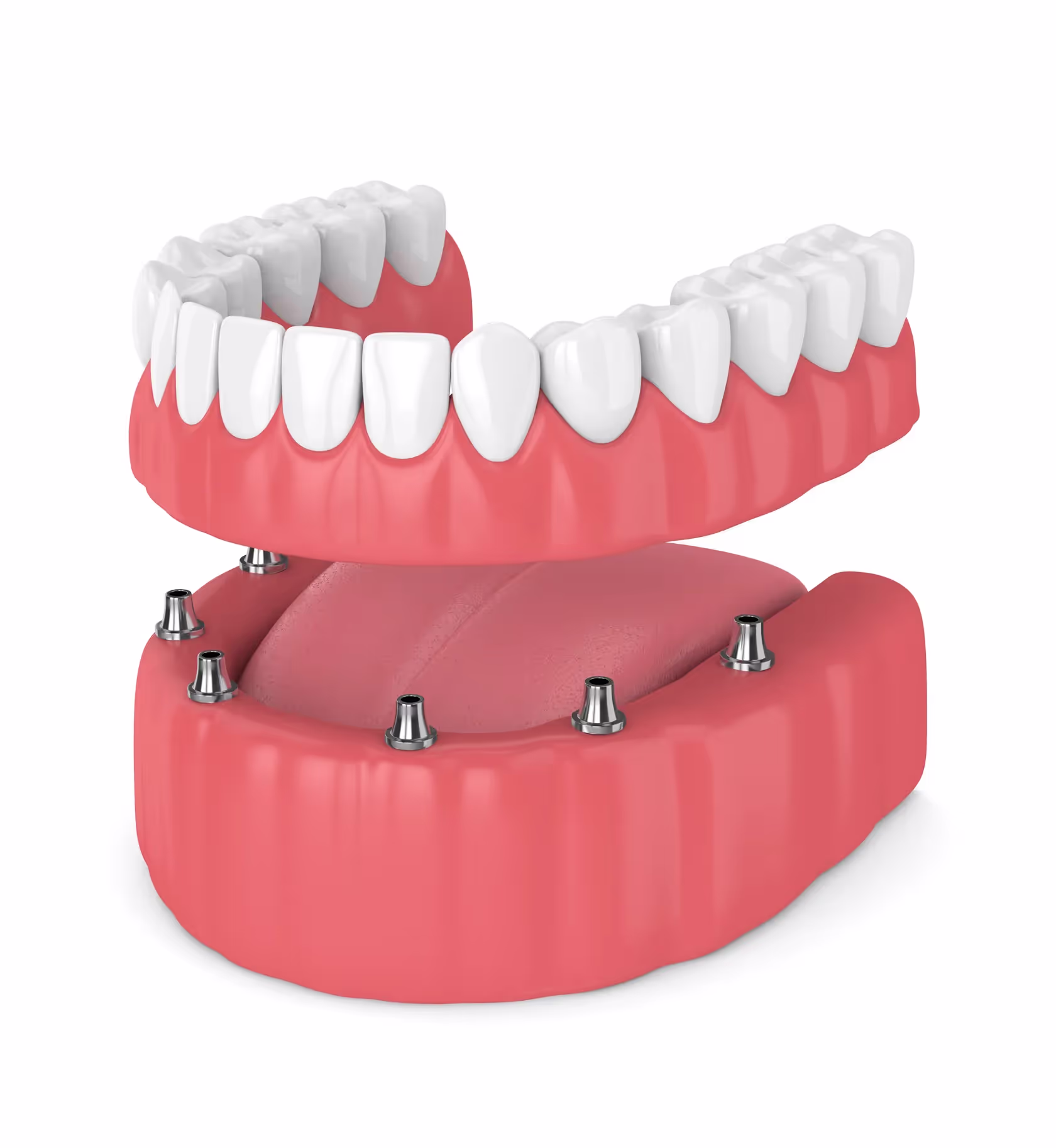 Removable Implant Dentures