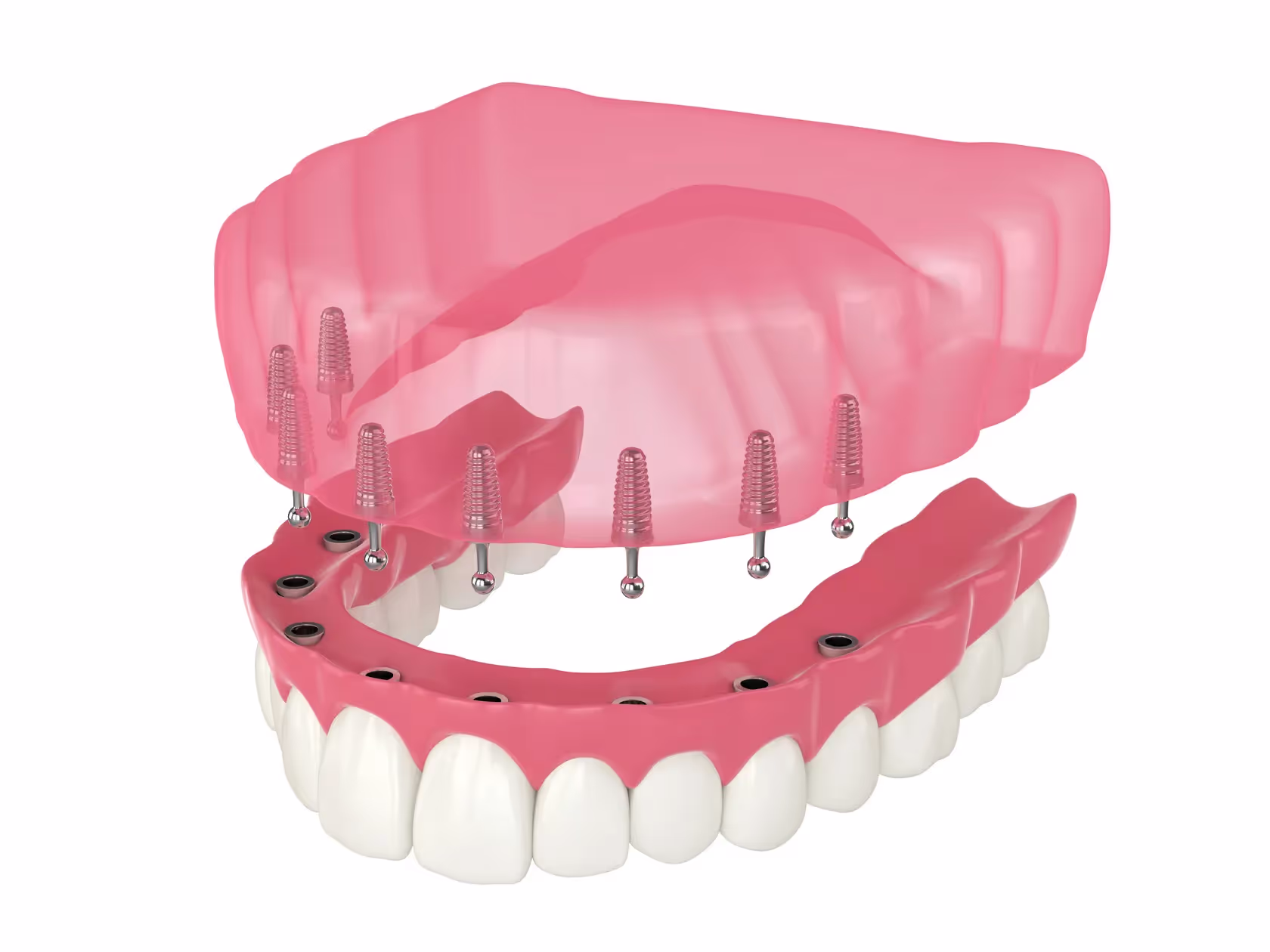 Snap-in Dentures