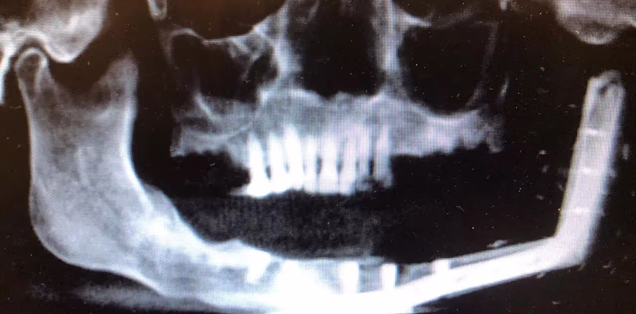 Maxillofacial prosthodontist Houston – oral rehabilitation care, view of an x-ray