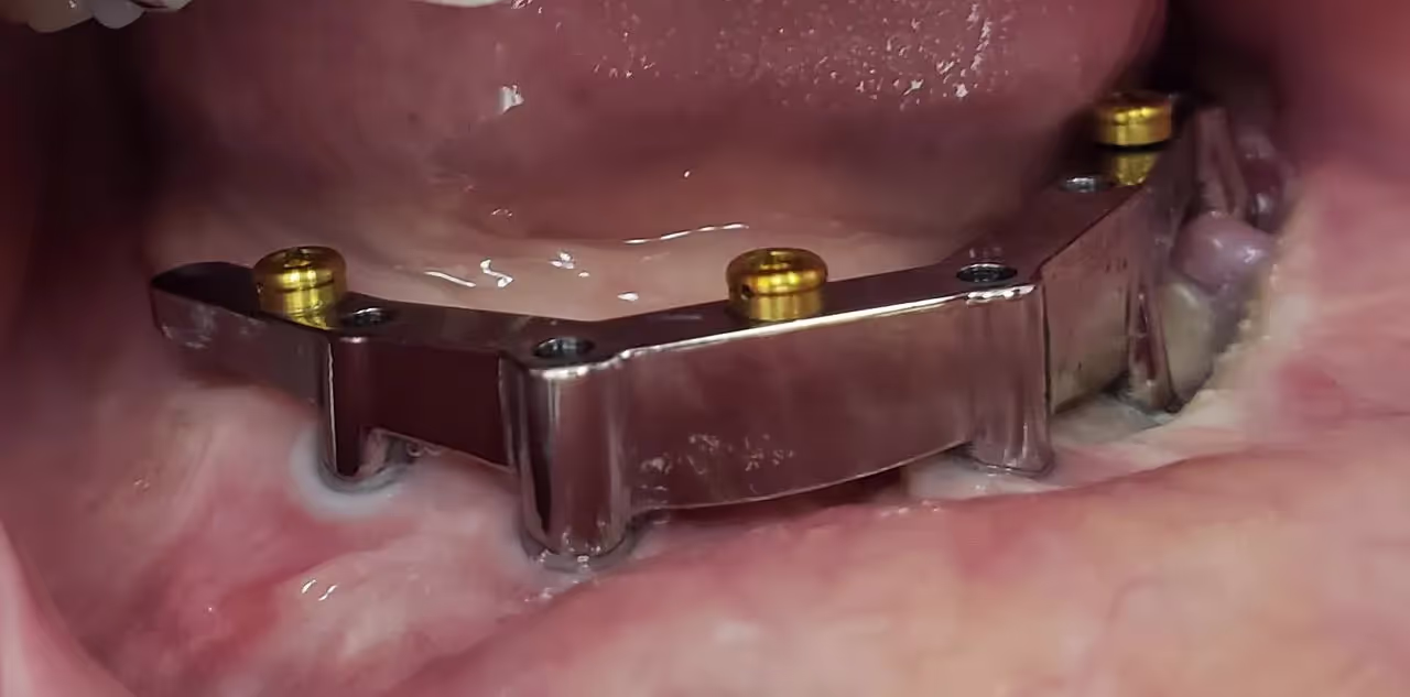 Maxillofacial Prosthodontics