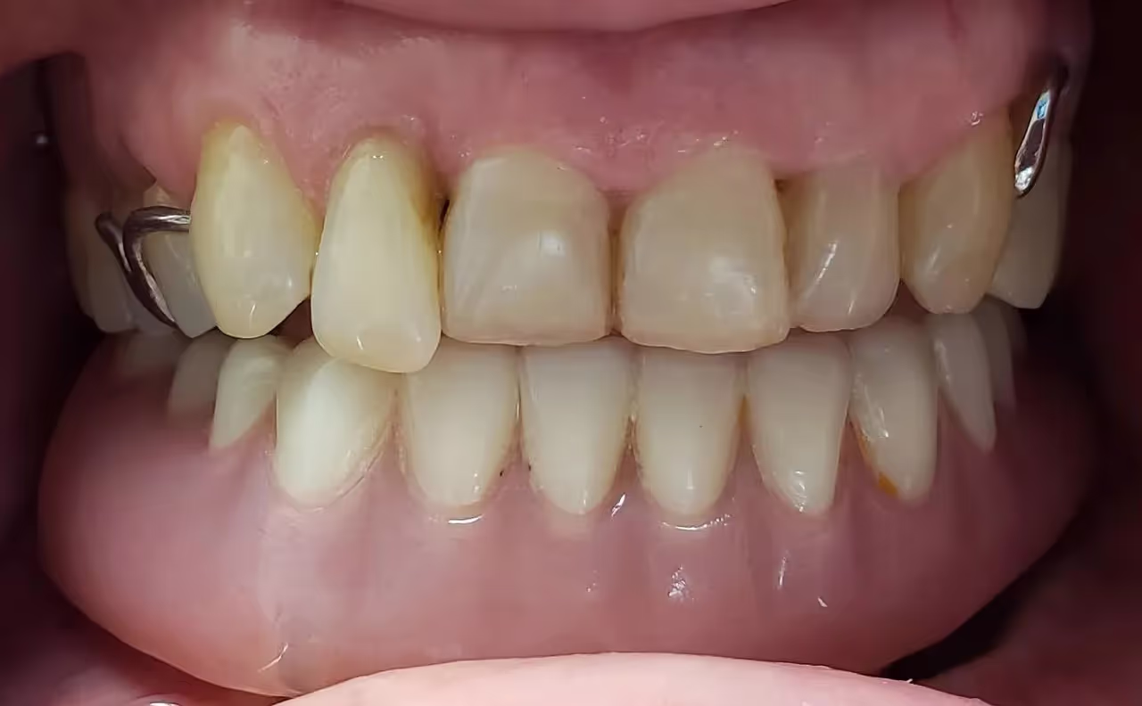 Maxillofacial Prosthodontics