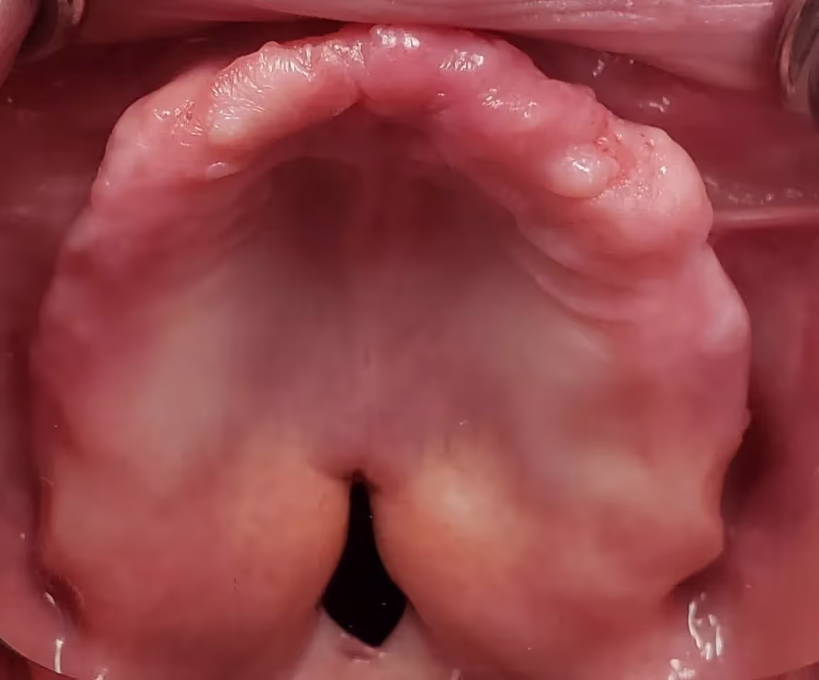 Maxillofacial Prosthodontics