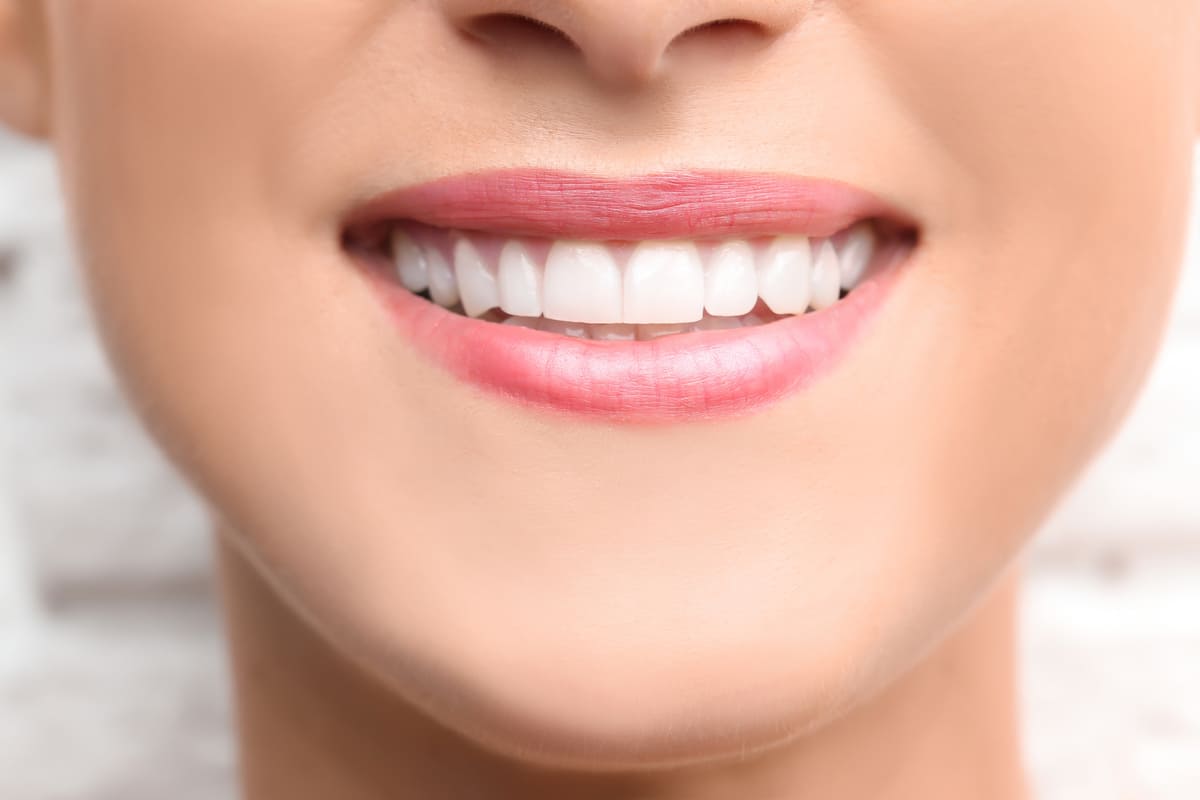 Smile makeover by cosmetic dentist Houston TX